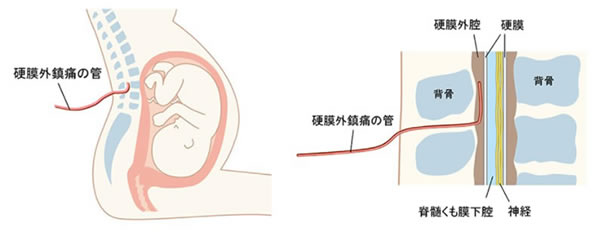 硬膜外鎮痛の説明イラスト